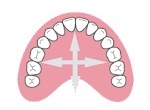 歯列のアーチを拡げる